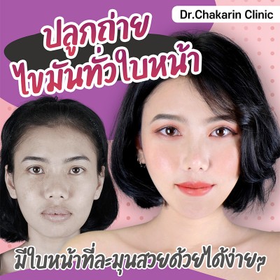 ปลูกถ่ายไขมันทั่วใบหน้า