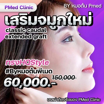 เสริมจมูกใหม่ classic caudal extended graft